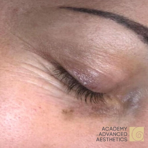 Retix.C EYE+_before_2