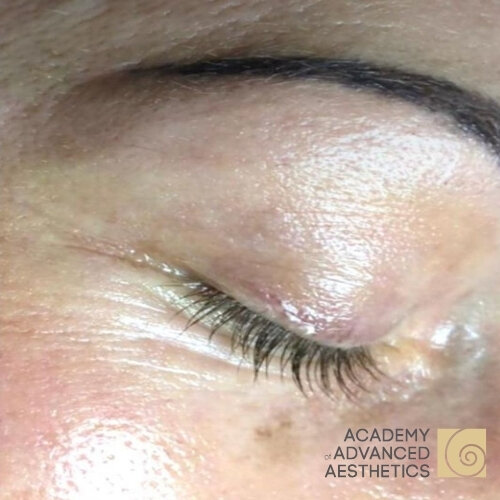 Retix.C EYE+_after_2