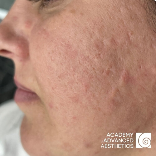 Retix.C Peptiglow Retiskin.LAB_before_1