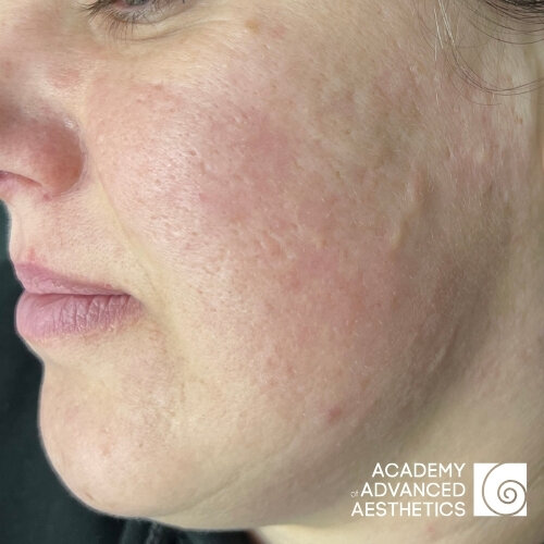 Retix.C Peptiglow Retiskin.LAB_after_1