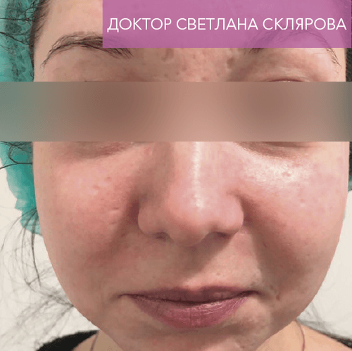 Endoret PRGF_after_2