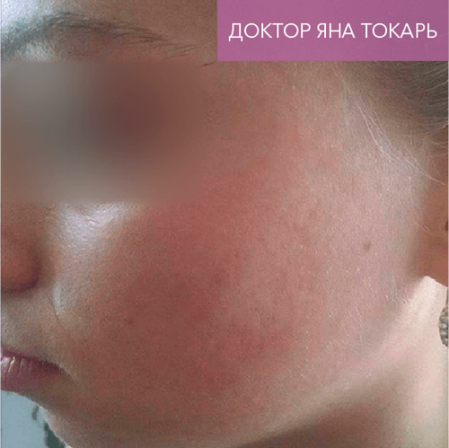 Endoret PRGF_after_4