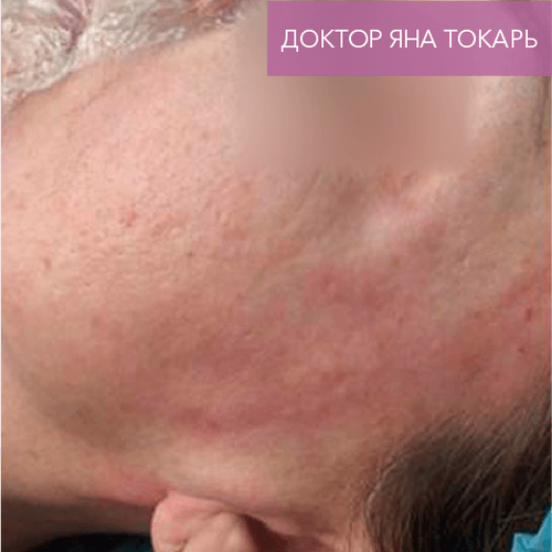 Endoret PRGF_before_7