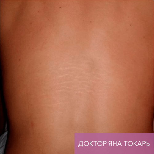 Endoret PRGF_before_9