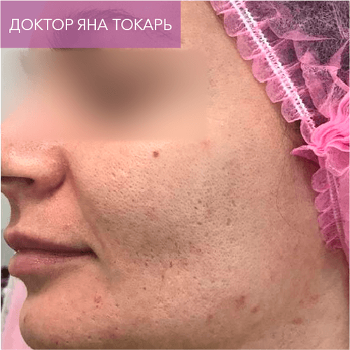 Endoret PRGF_before_11