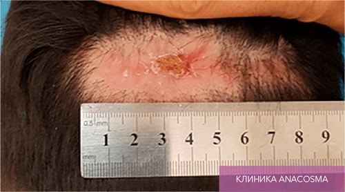 Endoret PRGF_before_16