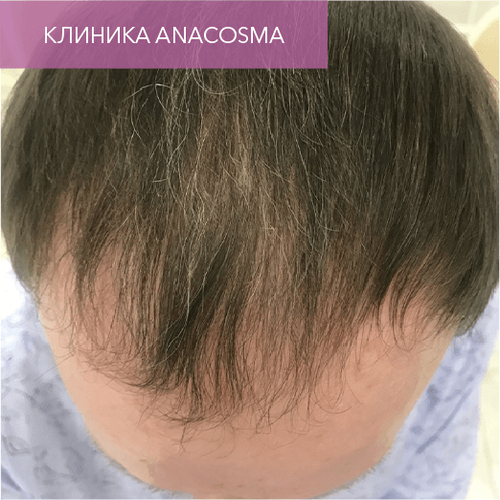 Endoret PRGF_after_17