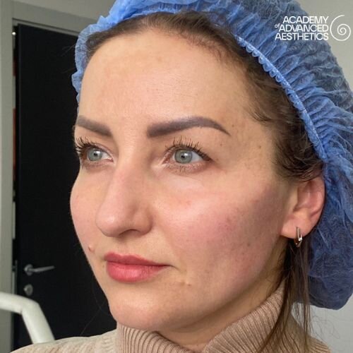 Radiesse_after_6