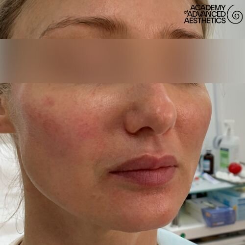 Radiesse_after_4