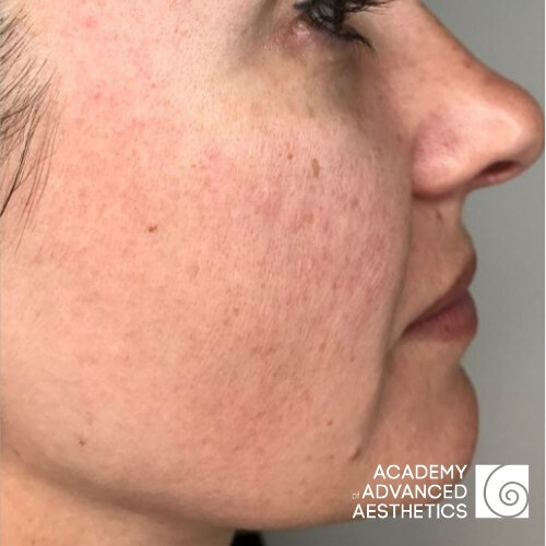 Retix.C Retibooster_before_1