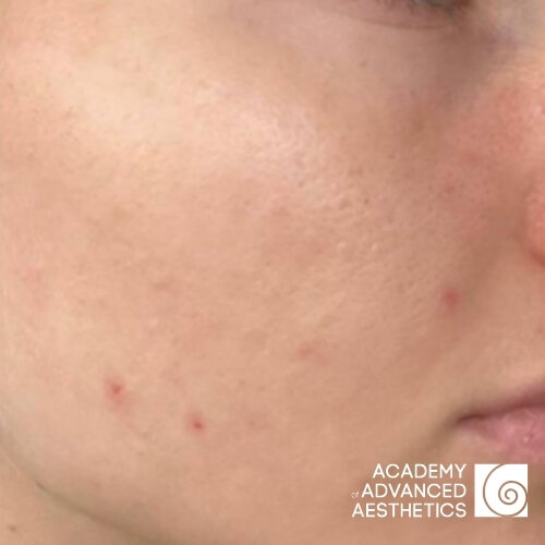 Retix.C Retibooster_after_1