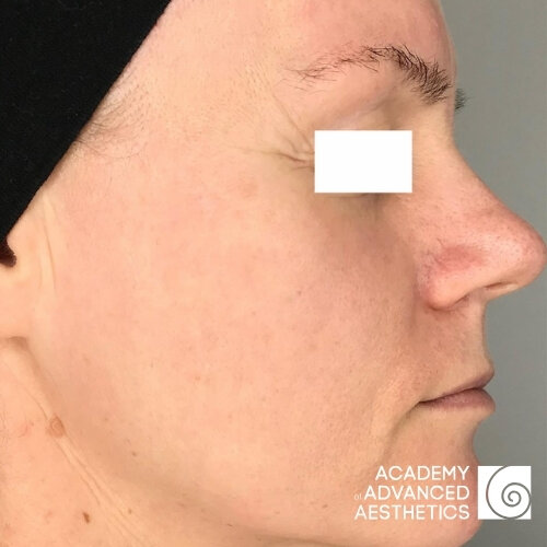 Retix.C Retibooster_after_2