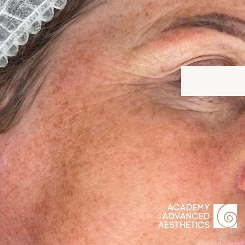 Retix.C Smart DNA Therapy_before_2