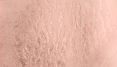 Лікування розтяжок