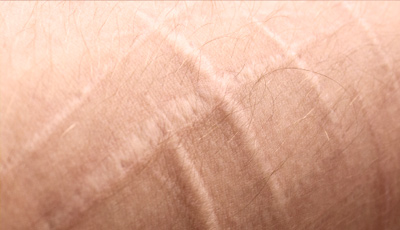 Лікування рубців