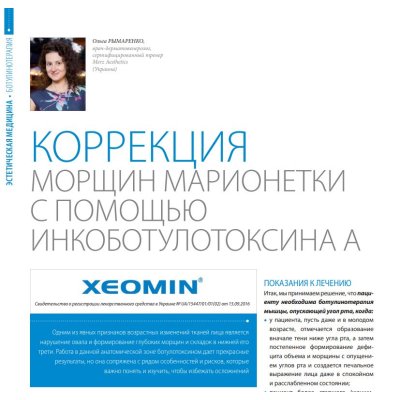 Корекція зморшок маріонеток за допомогою інкоботулотоксину А