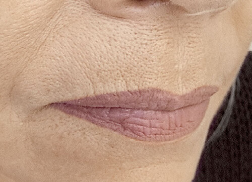 Експертні знання з унікальної техніки 'Бланшинг'  філерами Belotero _before_1