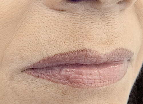 Belotero Soft & Balance_after_1