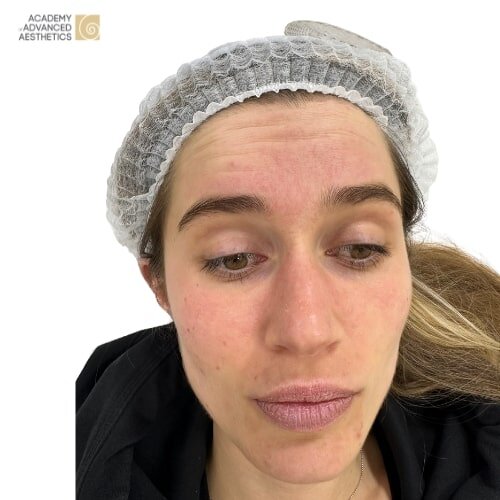 Botulinumtoxin_before_1