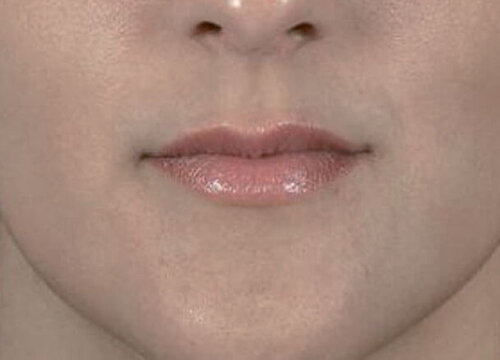 Belotero Intense_before_1