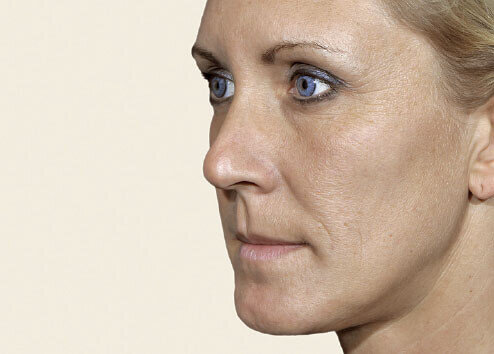 Belotero Volume_before_1