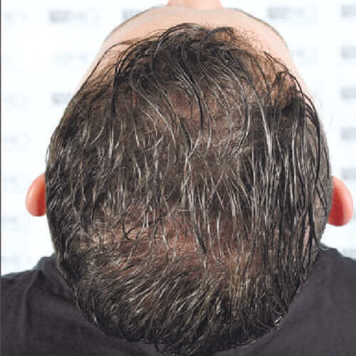 Чисті екзосоми - ключовий фактор стовбурових клітин у естетиці_after_2