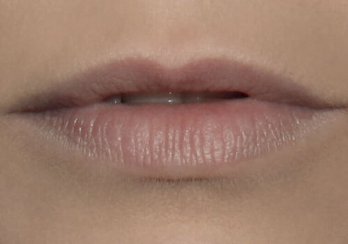 Belotero Lips Shape & Contour_before_1