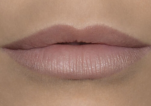Belotero Lips Shape & Contour_after_1