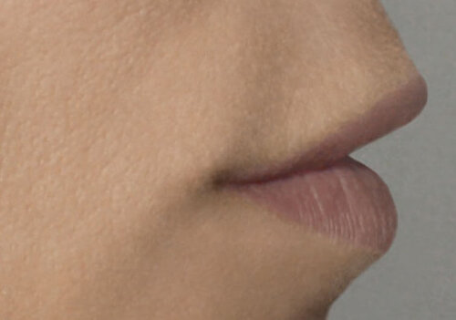 Belotero Lips Shape & Contour_before_1