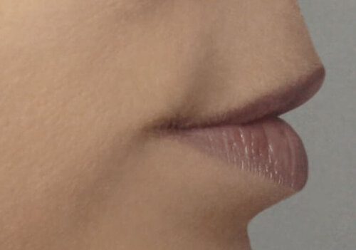 Belotero Lips Shape & Contour_after_1