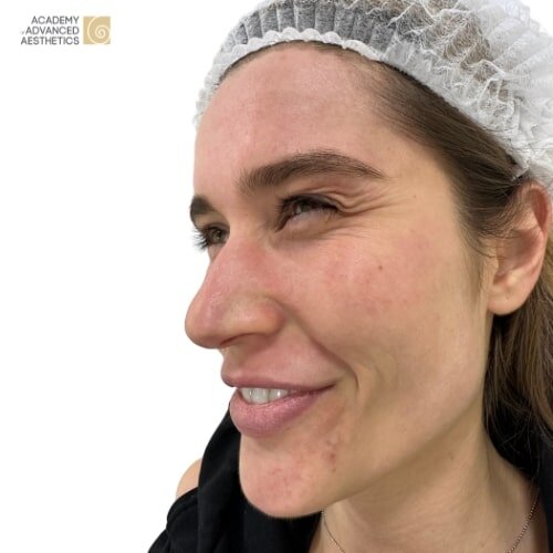 Botulinumtoxin_before_1