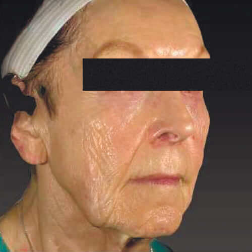 Чисті екзосоми - ключовий фактор стовбурових клітин у естетиці_before_4