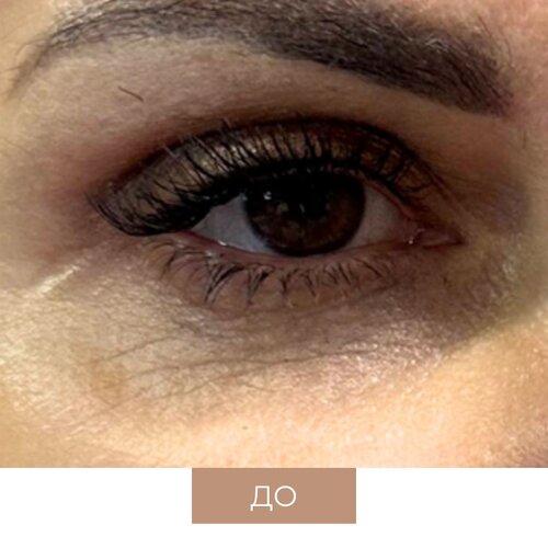 ДО Rejuran I EYE+ RetixC.jpg