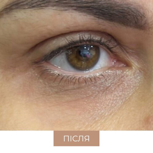 ПІСЛЯ Rejuran I EYE+ RetixC.jpg