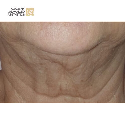 Juvelook & Lenisna_before_2