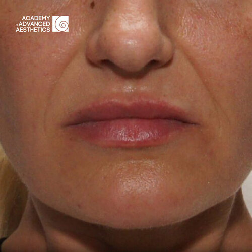 Juvelook & Lenisna_before_3