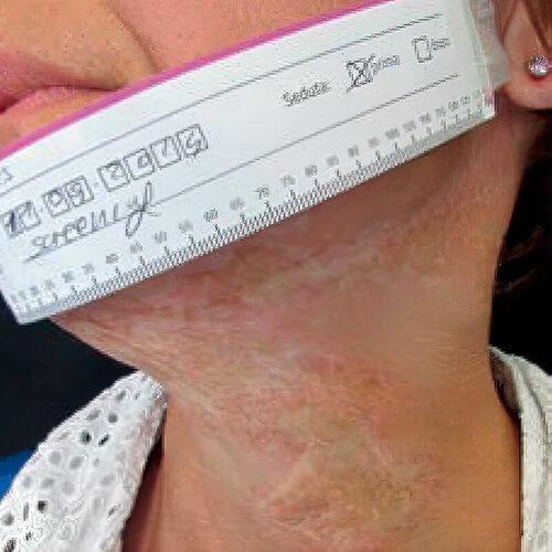 Лікування рубців_before_1