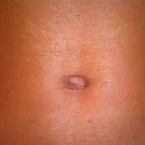 Лікування розтяжок_after_1