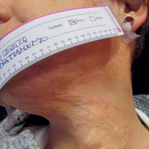 Лікування рубців_after_1