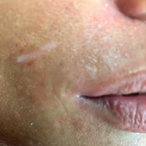 Лікування рубців_before_2