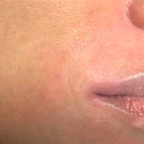 Лікування рубців_after_2