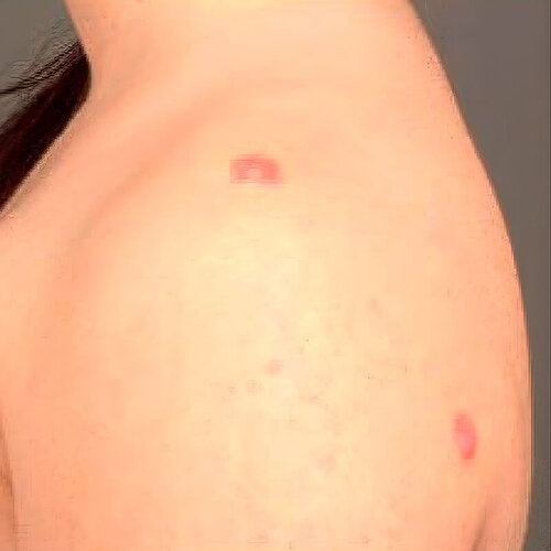 Лікування рубців_before_2