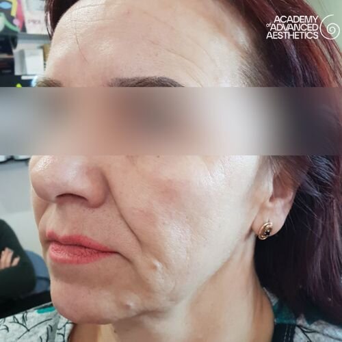 Radiesse_before_1