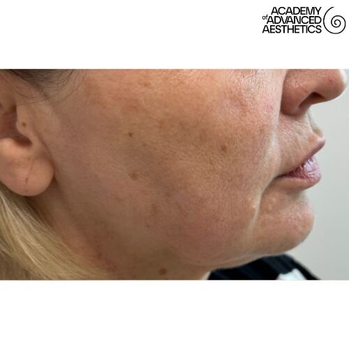 Radiesse_before_6