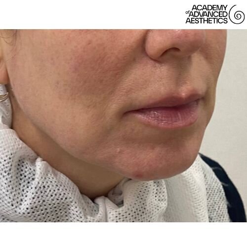Radiesse_before_2