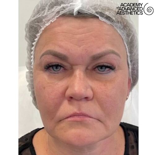 Radiesse_before_4