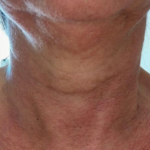 Double Tite_before_1