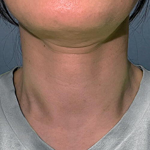 Double Tite_before_2