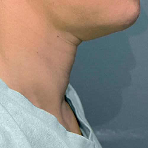 Double Tite_before_2