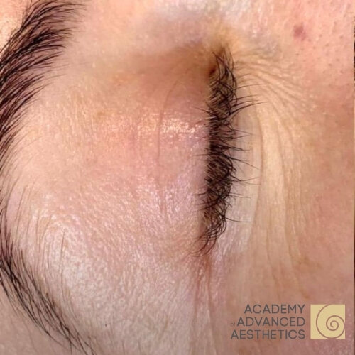 Retix.C EYE+_before_1